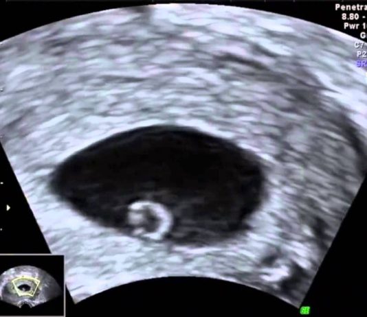 Gebeliğin/Hamileliğin 5. Haftası